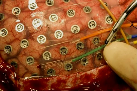 当然也有直接往人脑里塞电极的猛士。图为国外神经外科手术的照片。