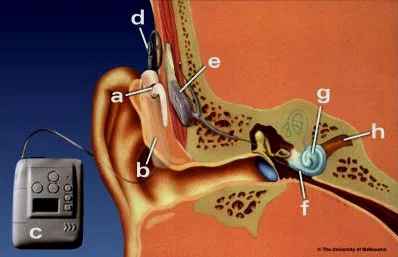 真正成功大规模应用的脑机接口产品——人工耳蜗，这还得感谢人类听觉神经系统对电极惊人的适应性和可塑性。